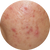 Large Pores & Blemishes menu image